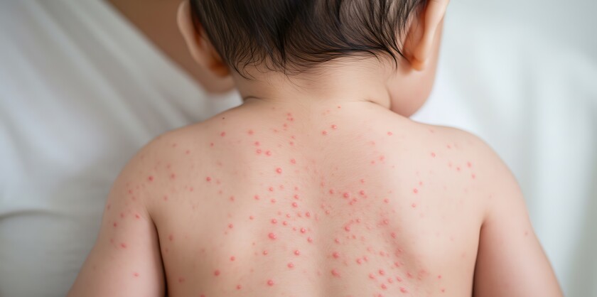 A baby with measles.